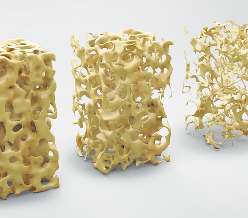 Bone structure 3d illustration, normal and with osteoporosis